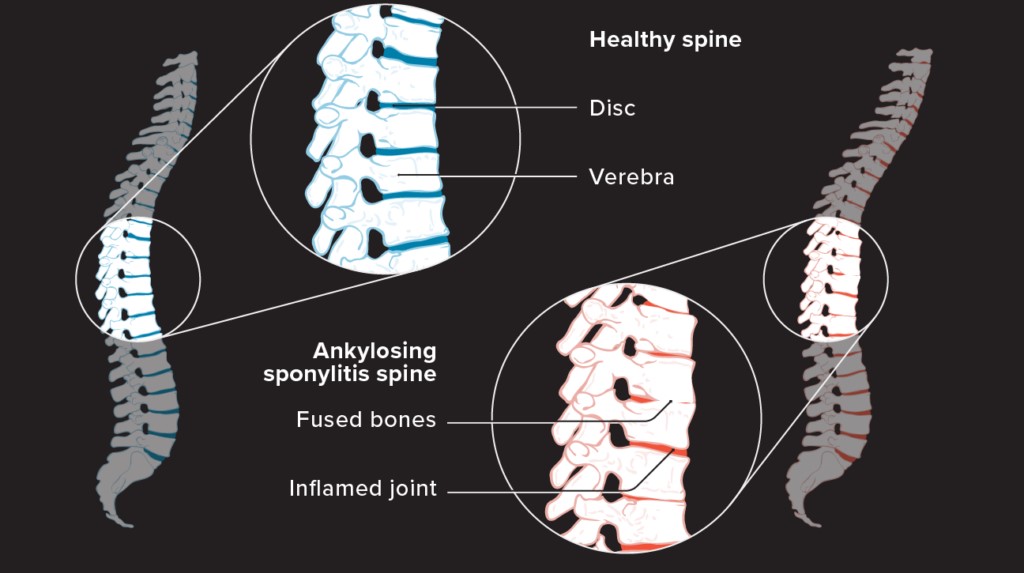 2255338-What-to-know-about-ankylosing-spondylitis_1296x972_body-1024x769