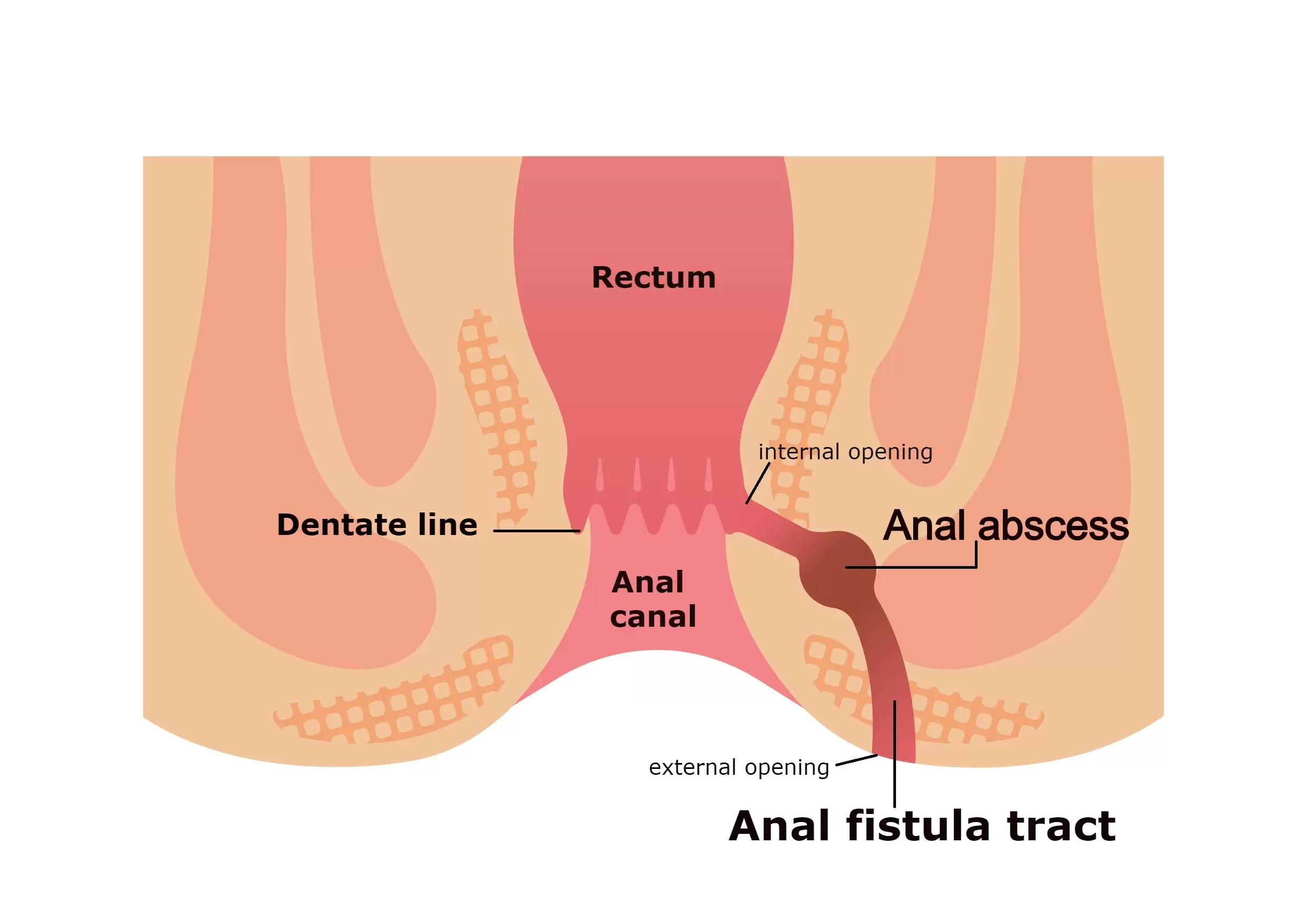 Anal-Fistula-with-labelling