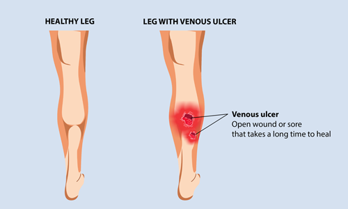 venous-leg-ulcer-1