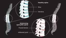 2255338-What-to-know-about-ankylosing-spondylitis_1296x972_body-1024x769
