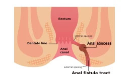 Anal-Fistula-with-labelling