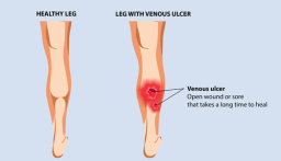 venous-leg-ulcer-1