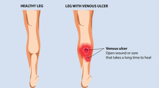 venous-leg-ulcer-1